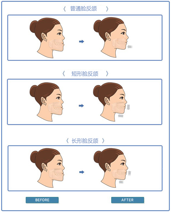 大部分情况为了反颌的效果都会将牙齿矫正和下巴手术一起进行的.