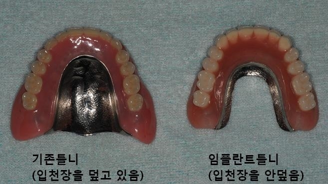 미니 임플란트 틀니